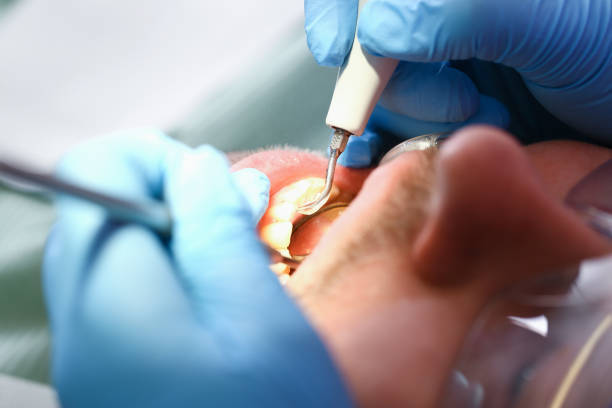 Best Emergency Wisdom Teeth Removal in Weed, CA